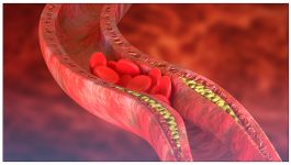 Atherosclerosis