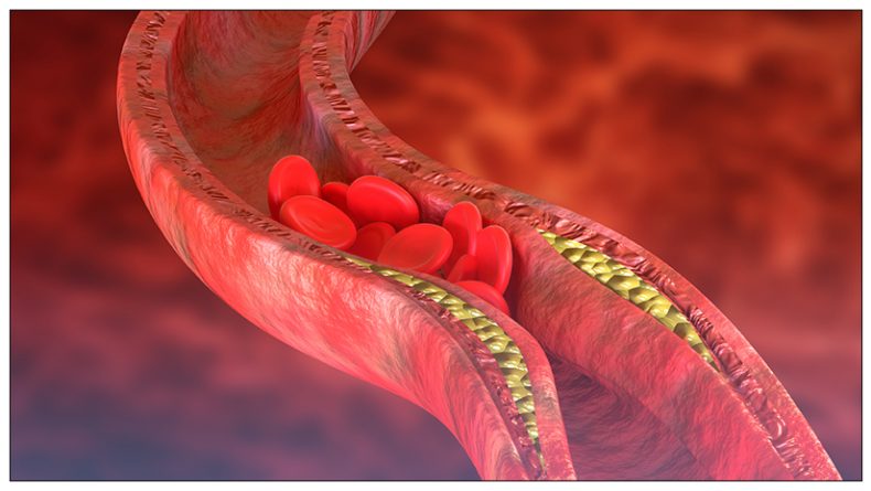 Atherosclerosis