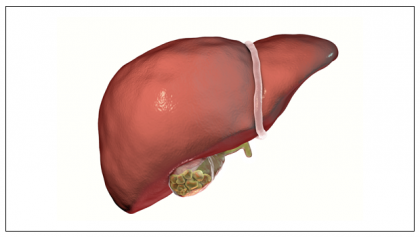 GALLBLADDER STONES: CAUSES, RISKS, DIET, AND MORE