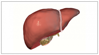 GALLBLADDER STONES:  CAUSES, RISKS, DIET, AND MORE