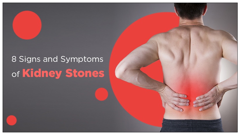8 Signs and Symptoms of Kidney Stones