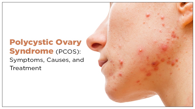 Polycystic-Ovary-Syndrome-(PCOS):-Symptoms,-Causes,-and-Treatment